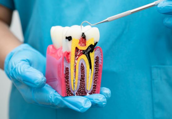 Signs You Need Root Canal
