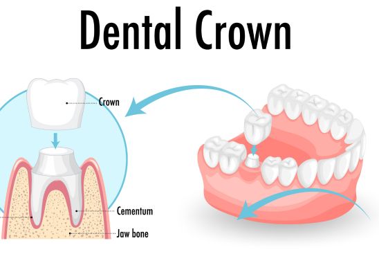 Benefits of Dental Caps