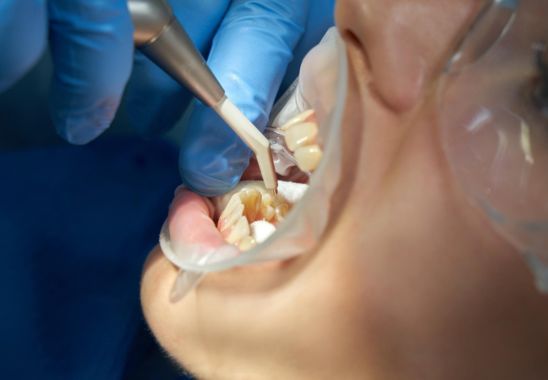Aftercare Tips For Tooth Extraction