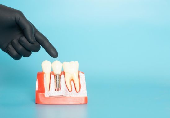 What Are Dental Implants?