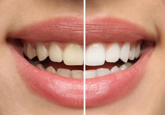Professional Teeth Whitening Benefits
