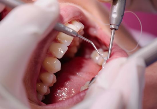 Tooth Extraction Procedure